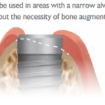 Ideal implant for problematic conditions