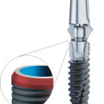 The implant neck with modified surface roughness is highlighted in red.