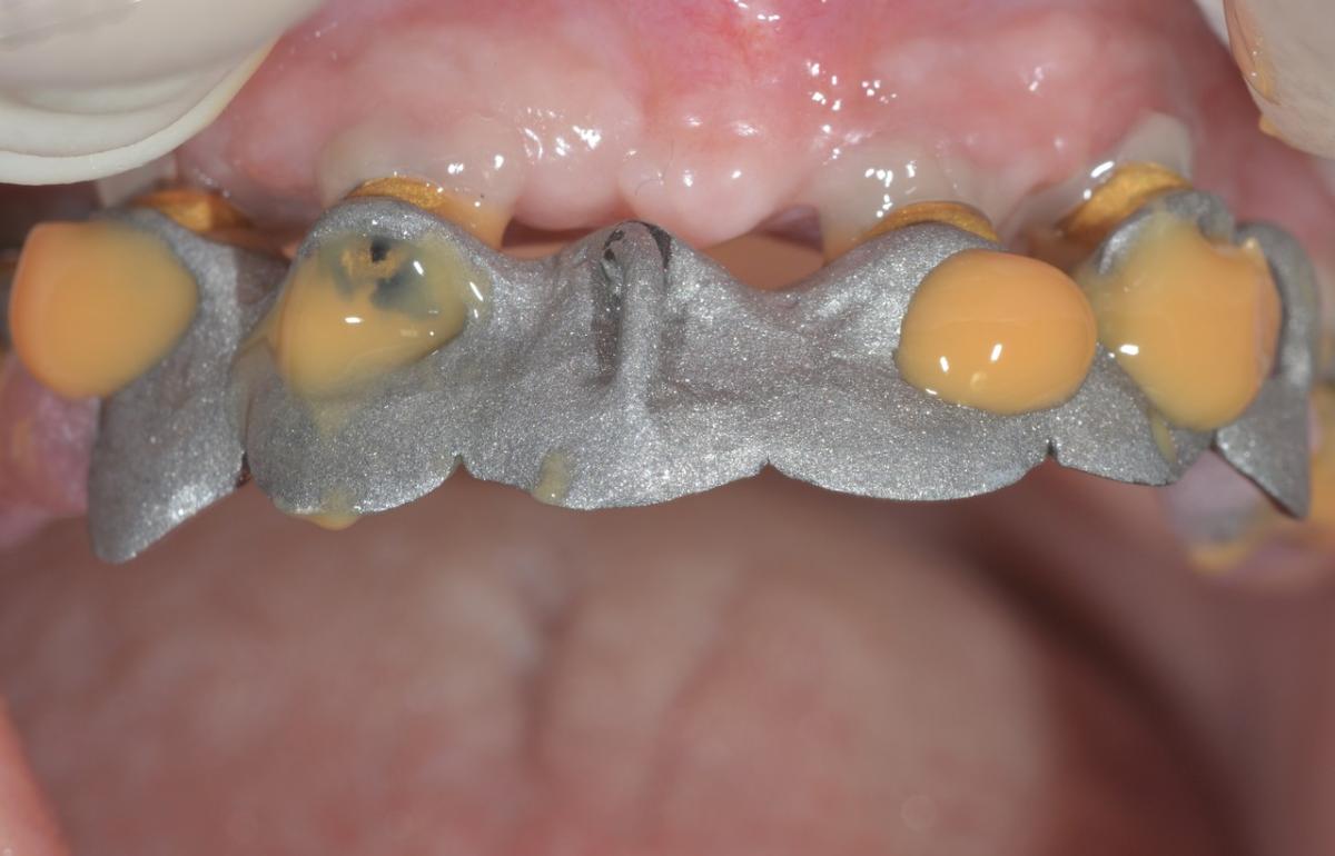 Extreme magnification of the intraoral bonding with tertiary structure 