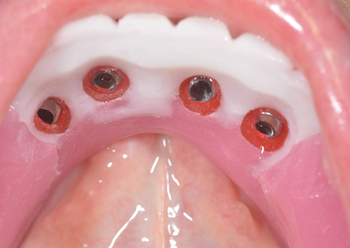 Screwed primary telescopes in the mandible. The implant control splint serves as an aesthetic template for the front teeth and as a bite registration carrier in one session.