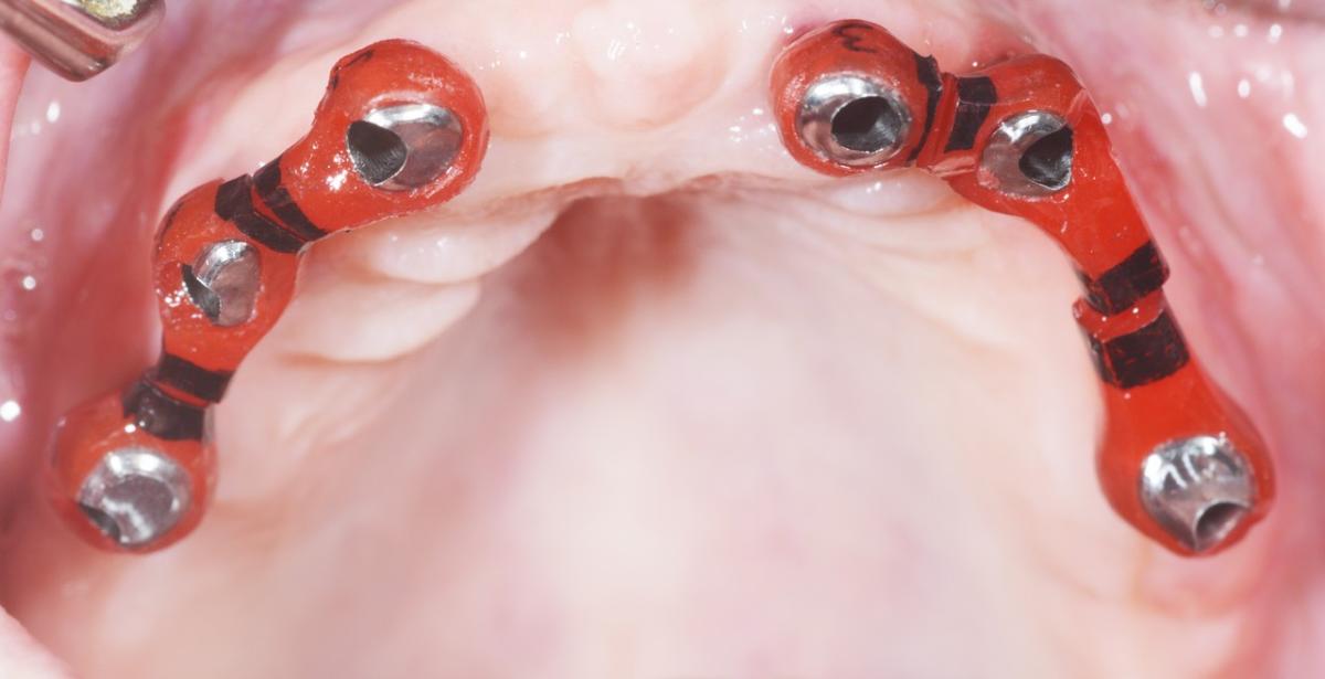 The same procedure is used in the maxilla, initially with implant control splints.