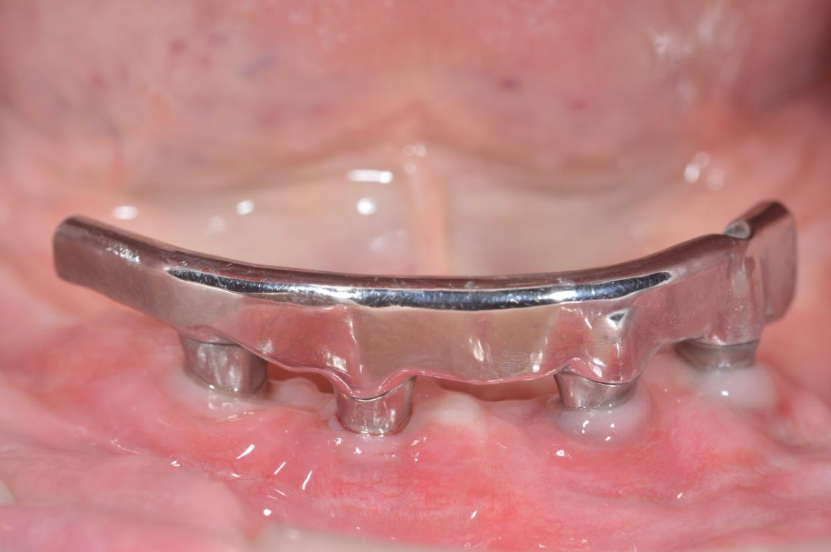 Construction with bar support in the mandible.