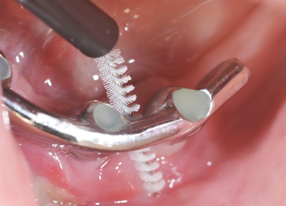 The mandibular bar can be cleaned.