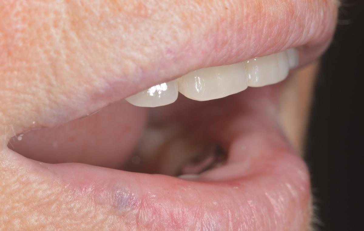 Side view of the final denture after completed treatment