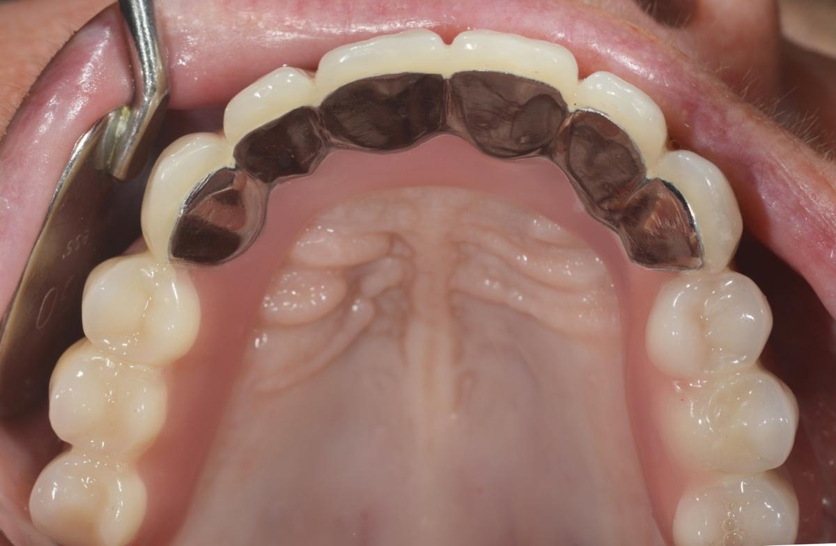 Completed treatment in the maxilla