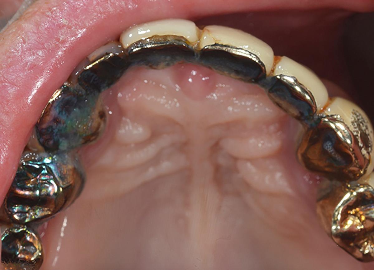 The patient's existing, approximately 35-year-old maxillary bridge