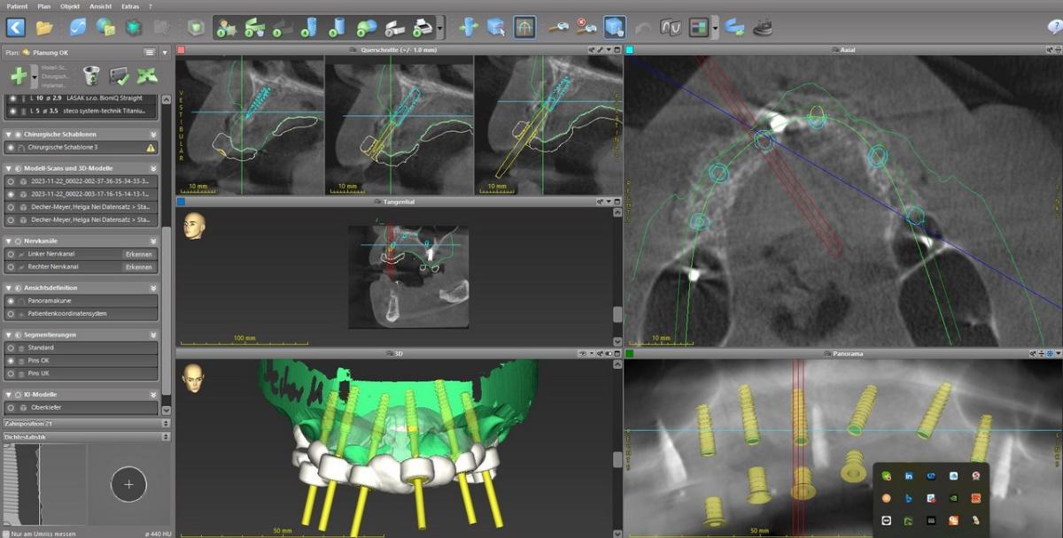 3D planning in the maxilla 