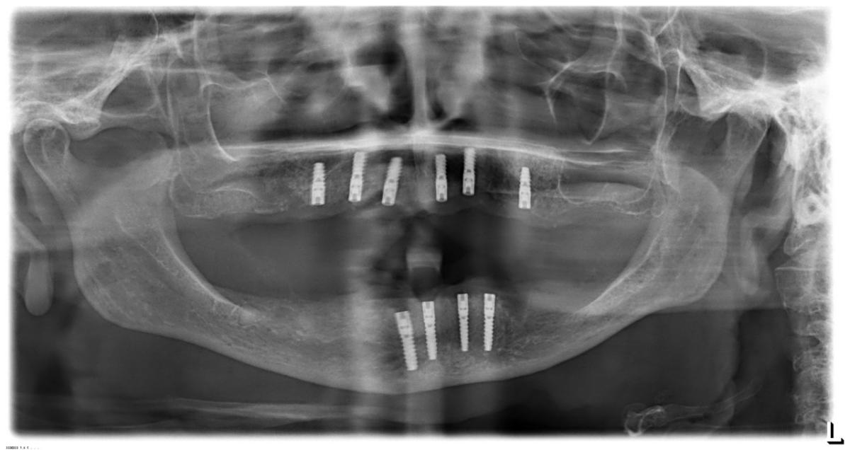 An OPG scan after insertion of all ten BioniQ implants