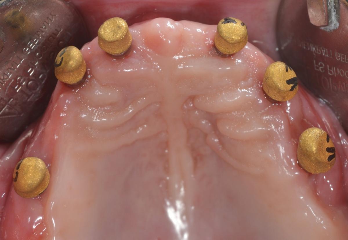 Connected galvanic secondary telescopes in the maxilla