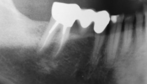 The situation before treatment with a subcoronally destroyed tooth 45 and a tooth 47, which was tender under pressure.