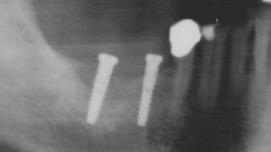 A control X-ray control showed there was sufficient implant length.