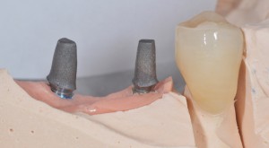 The two abutments, rough-blasted before intraoral cementation.