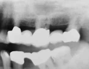 Tooth 26 is destroyed subcoronally.