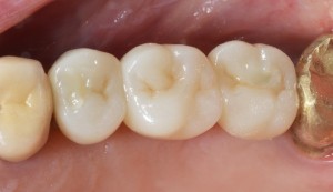 Occlusal closures with composite.