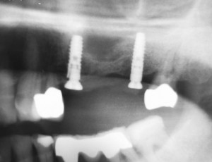 Postoperative control image. The gingiva former on 24 still has to be retightened.